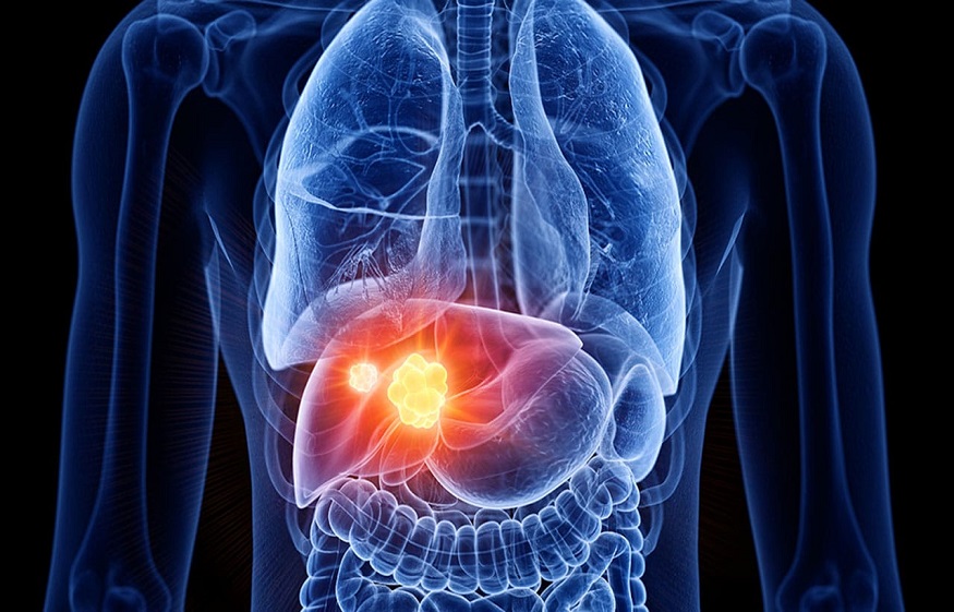 Treat Liver Cancer With Regorafenib